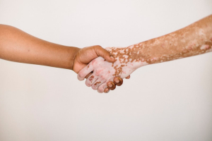 vitiligo strângere de mână