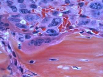 Cele mai recente tratamente pentru cancerul de prostată cu metastaze limfatice și osoase [2024]